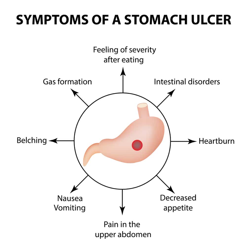 Most Common Symptoms, Causes, and Home Remedies Of Stomach Ulcer ... Be ...