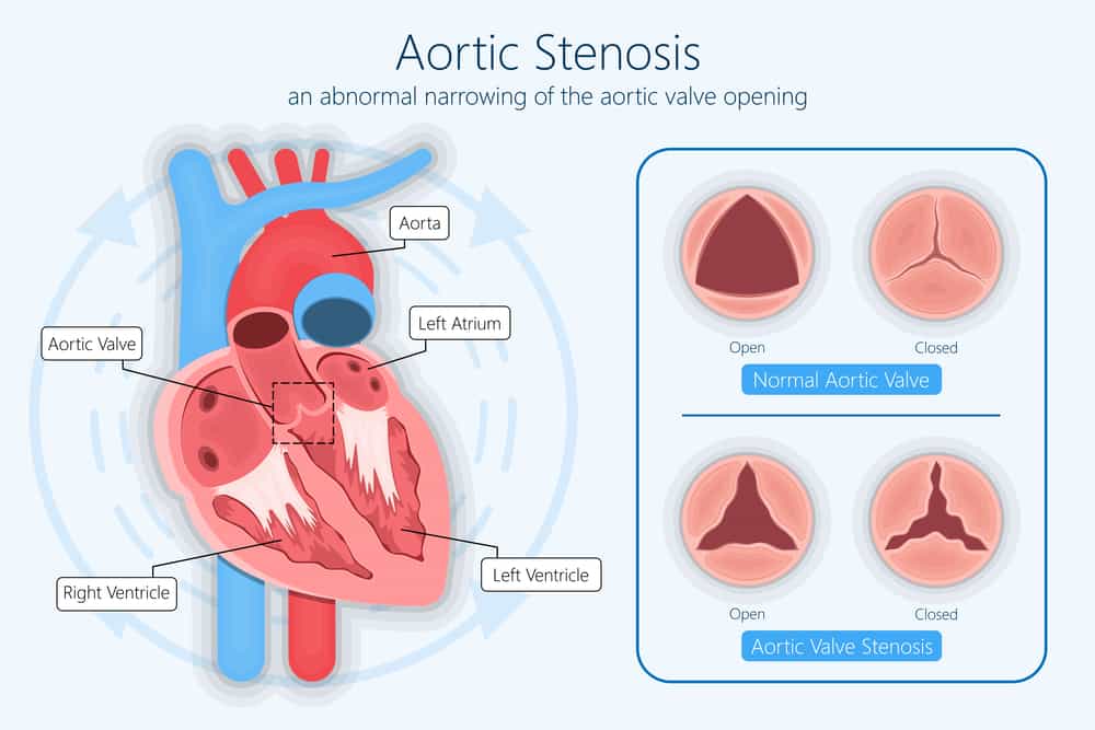 Heart Murmurs Overview Causes Signs Types Symptoms Diagnosis And