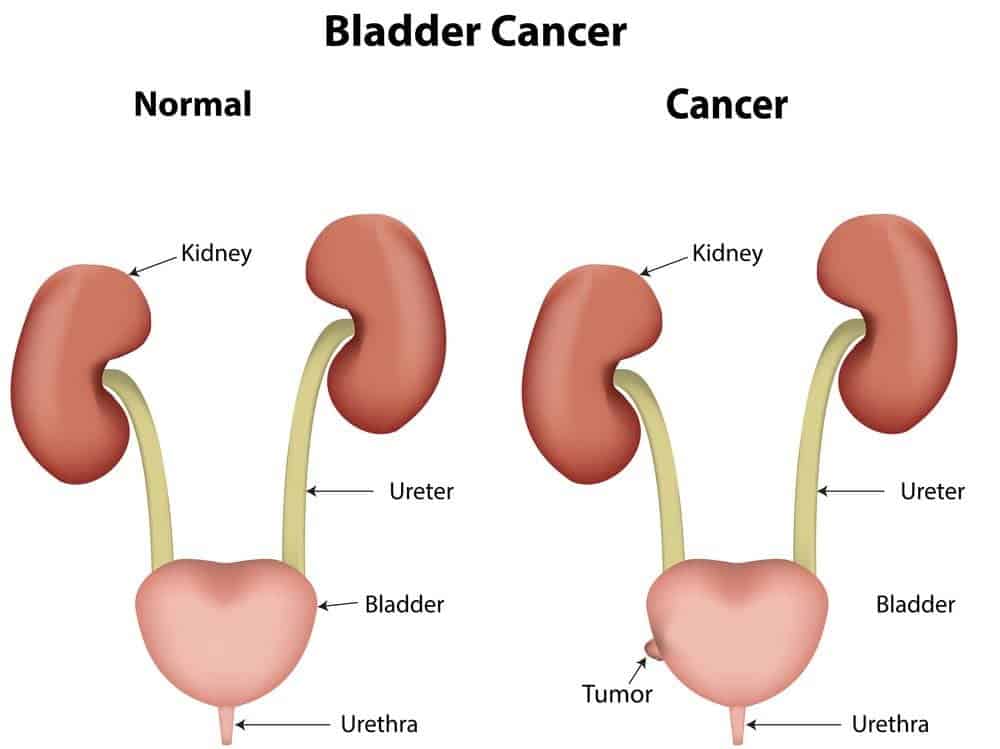 14 Scary Symptoms Of Bladder Cancer Every Woman And Man Needs To Know Thelifetoday 