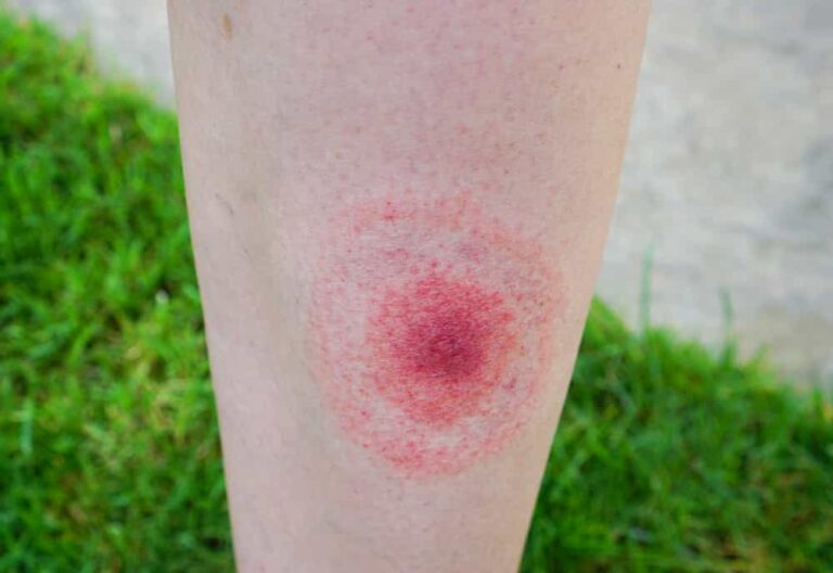 Everything You Need To Know About Lyme Disease: Overview, Causes, Types 