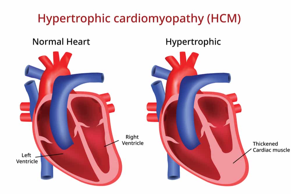 Heart Murmurs: Overview, Causes, Signs, Types, Symptoms, Diagnosis and ...