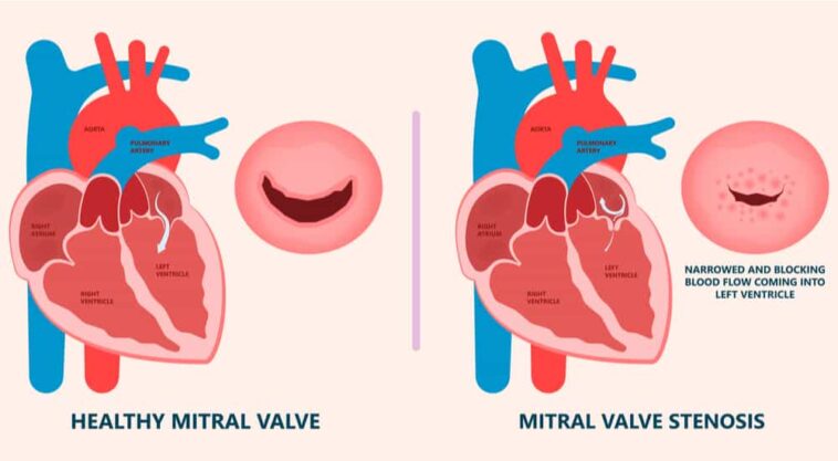 Heart Murmurs: Overview, Causes, Signs, Types, Symptoms, Diagnosis and ...