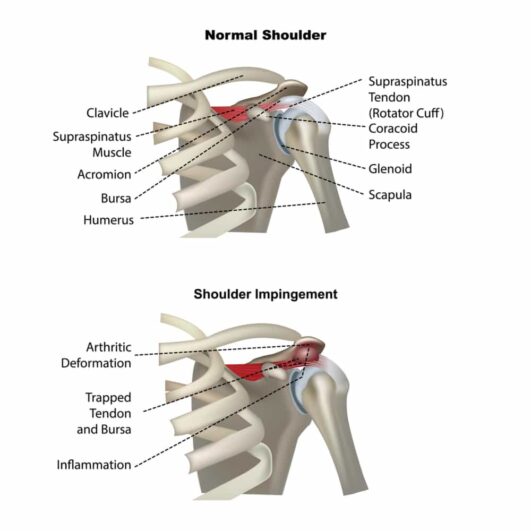 Shoulder Pain: Overview, Causes and Related Diseases, Signs and ...