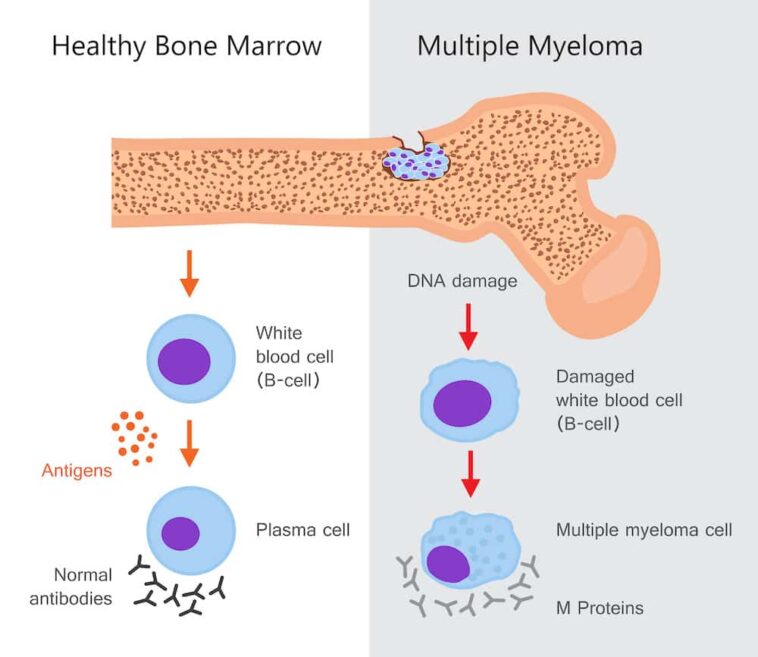 Multiple Myeloma Signs and symptoms, Causes, Stages, Types, Diagnosis