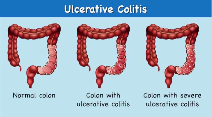 Everything You Need to Know About Ulcerative Colitis: Signs, Symptoms ...