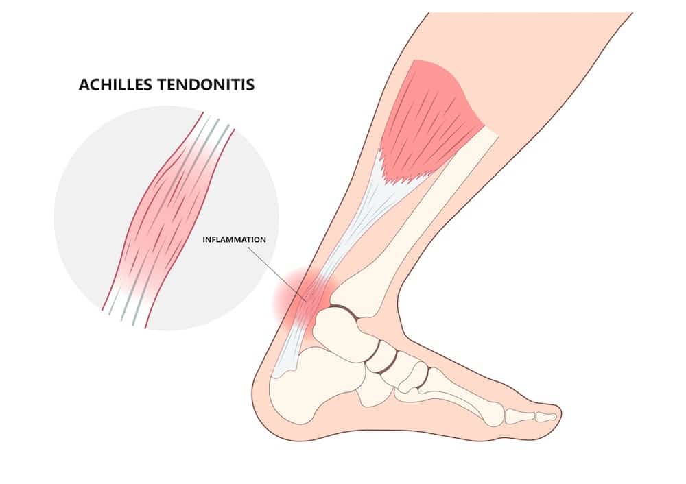 Leg Pain Causes: What May Cause Leg Pain? 16 Conditions That Can Cause ...