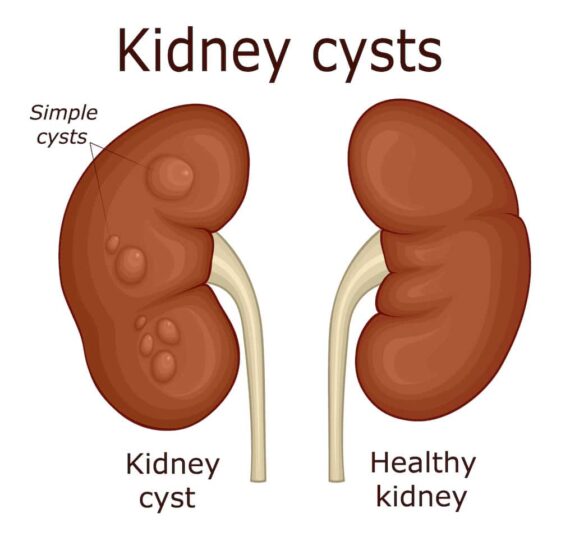 Kidney Cyst Symptoms: What You Need to Know About Kidney Cyst Signs and ...