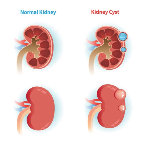 Kidney Cyst Symptoms: What You Need to Know About Kidney Cyst Signs and ...