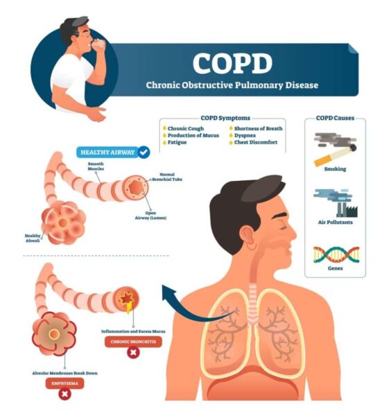 Copd Symptoms: Top Warning Signs, Chronic Bronchitis, Emphysema And 