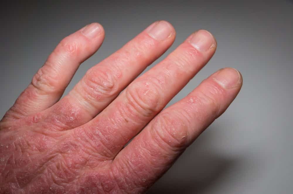 Psoriatic Arthritis: What Is Psoriatic Arthritis? Signs, Symptoms 