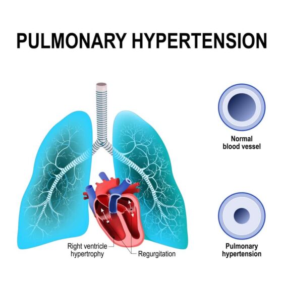 Copd Symptoms: Top Warning Signs, Chronic Bronchitis, Emphysema And 