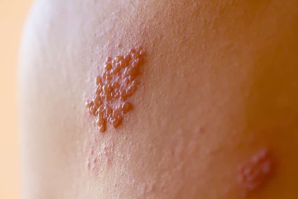 What Are The Symptoms Of Shingles? (herpes Zoster), 23 Warning Signs 