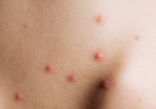 What Are The Symptoms Of Shingles? (herpes Zoster), 23 Warning Signs 